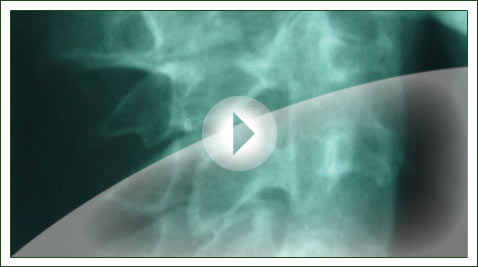 Klippel Feil Syndrome Video